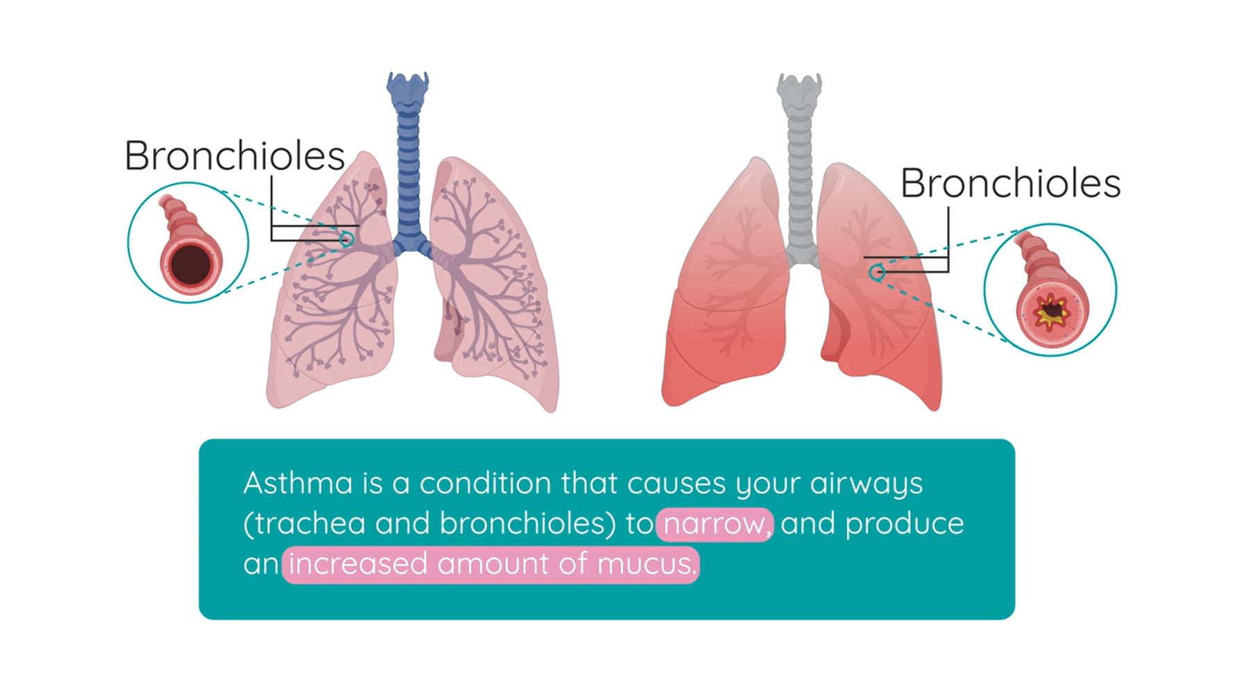 Breathing System Disorder: Asthma | Studyclix