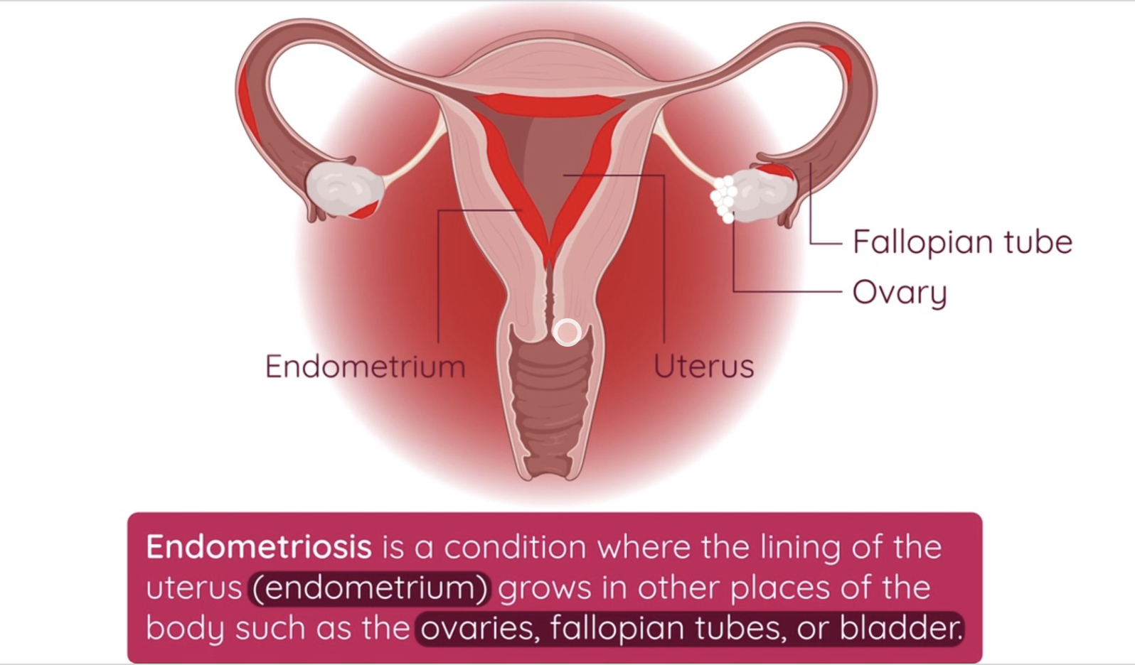 Menstrual Cycle Disorder | Endometriosis | Studyclix